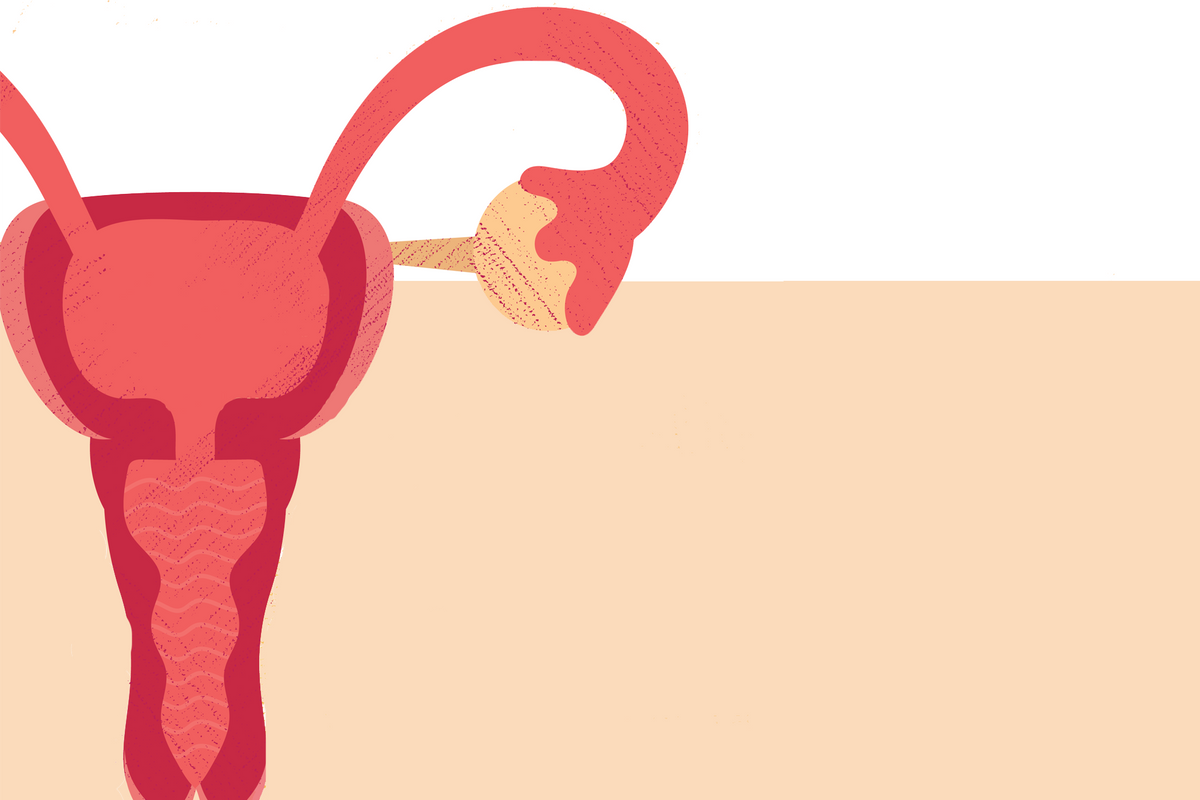 Radiofrequency Ablation Is a Treatment Option for Fibroids - HealthyWomen