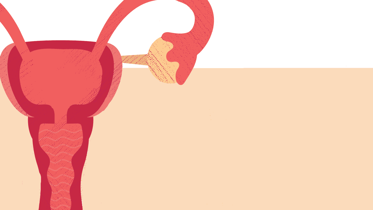 Radiofrequency Ablation (RFA) Is a Treatment Option for Fibroids