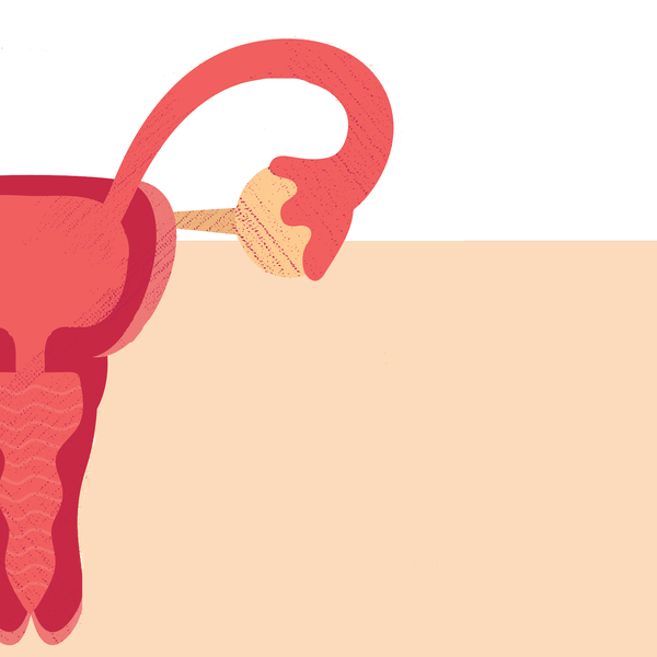 Radiofrequency Ablation (RFA) Is a Treatment Option for Fibroids