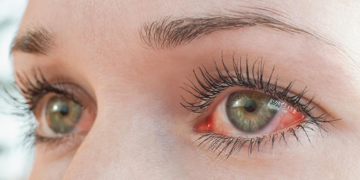 Thyroid Eye Disease 101 — TED/Graves's Eye Disease - HealthyWomen