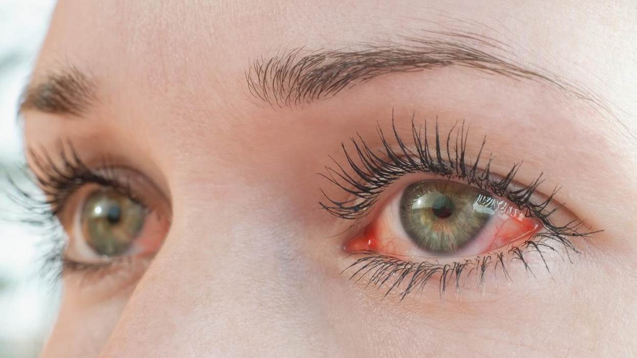 Thyroid Eye Disease 101
