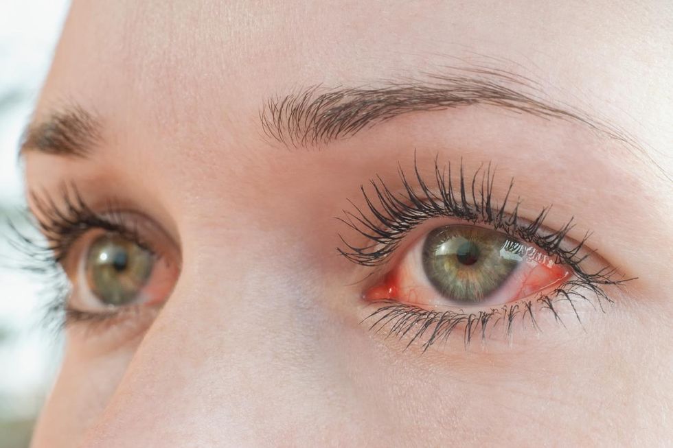 Tiroid Göz Hastalığı 101 — TED/Graves Göz Hastalığı