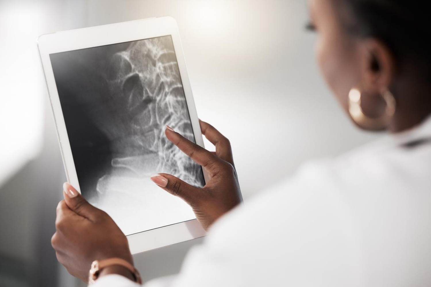 In an Aging America, Osteoporosis Is a Looming Public Health Crisis