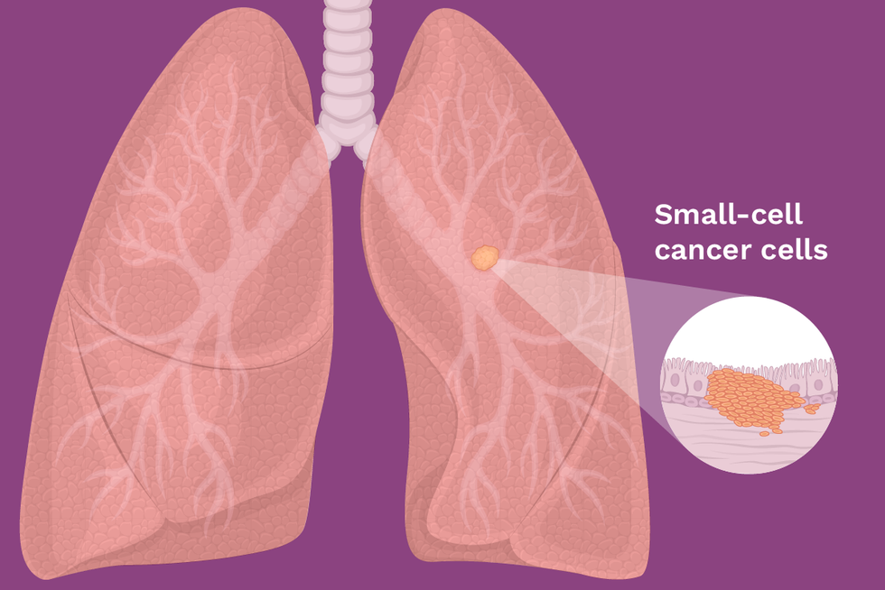 Small cell lung cancer