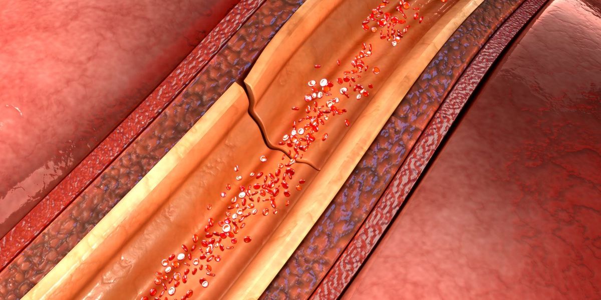 spontaneous coronary artery dissection