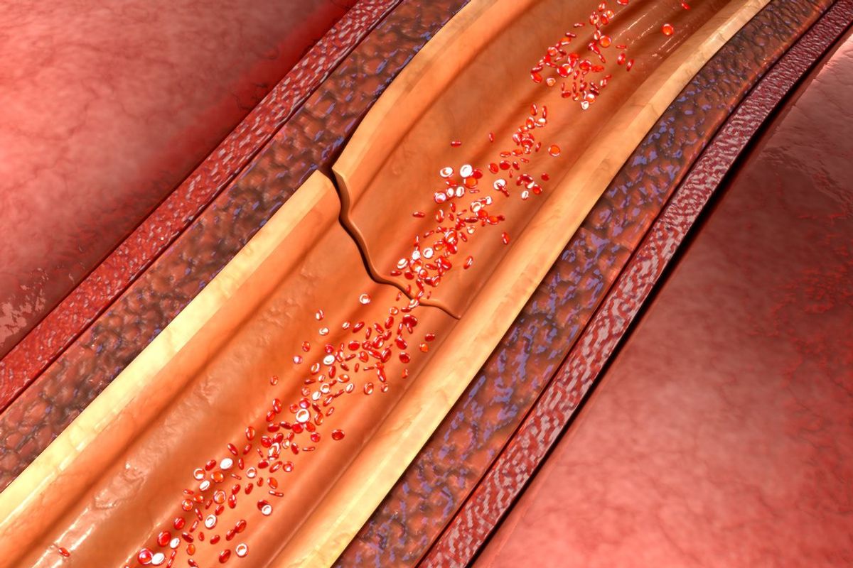 spontaneous coronary artery dissection