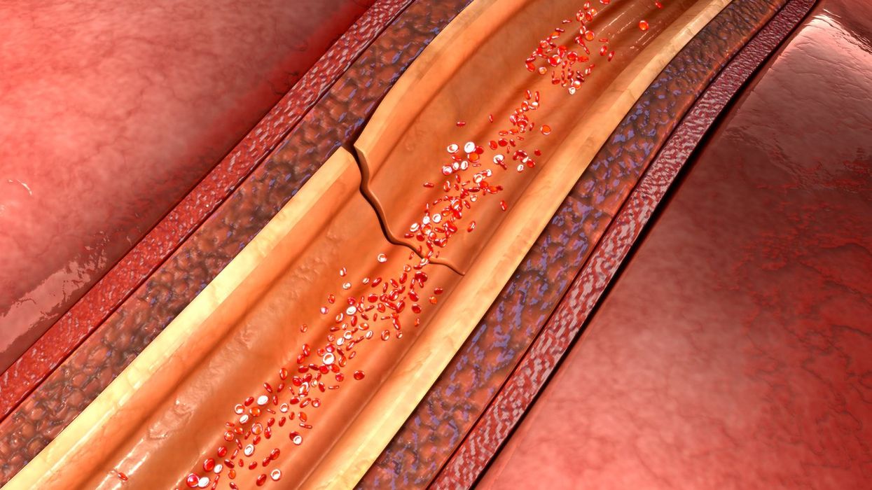 spontaneous coronary artery dissection