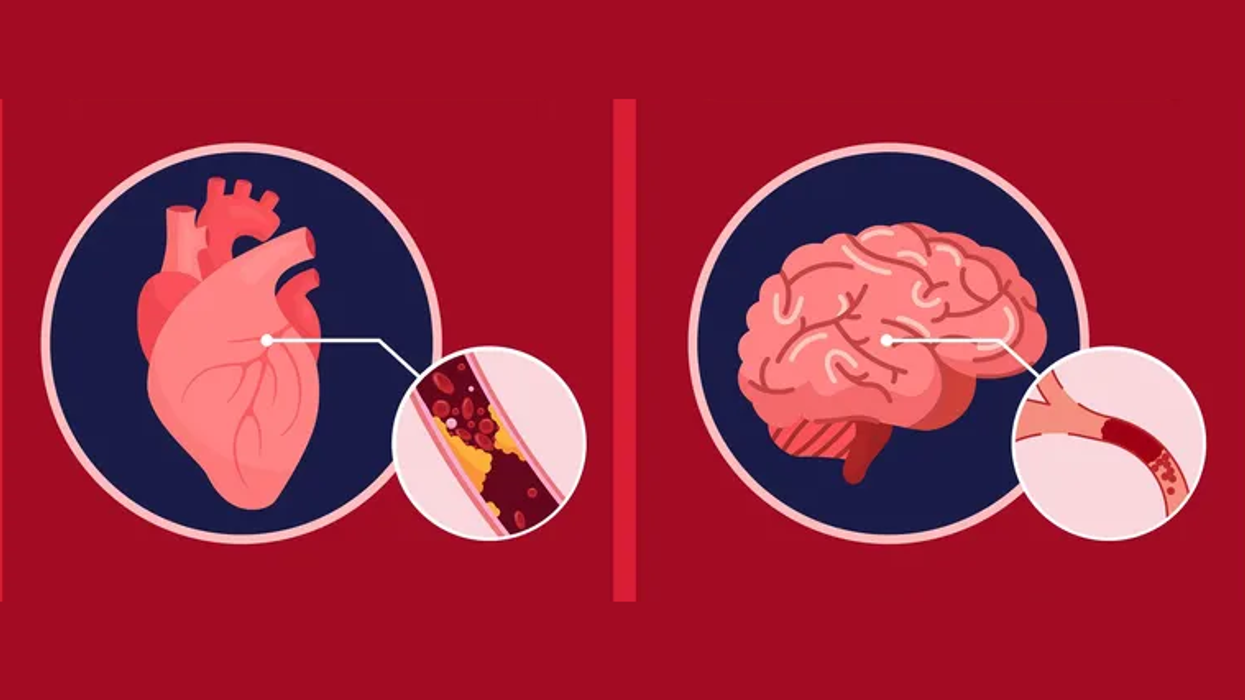 Stroke vs. Heart Attack: Know the Signs & Symptoms