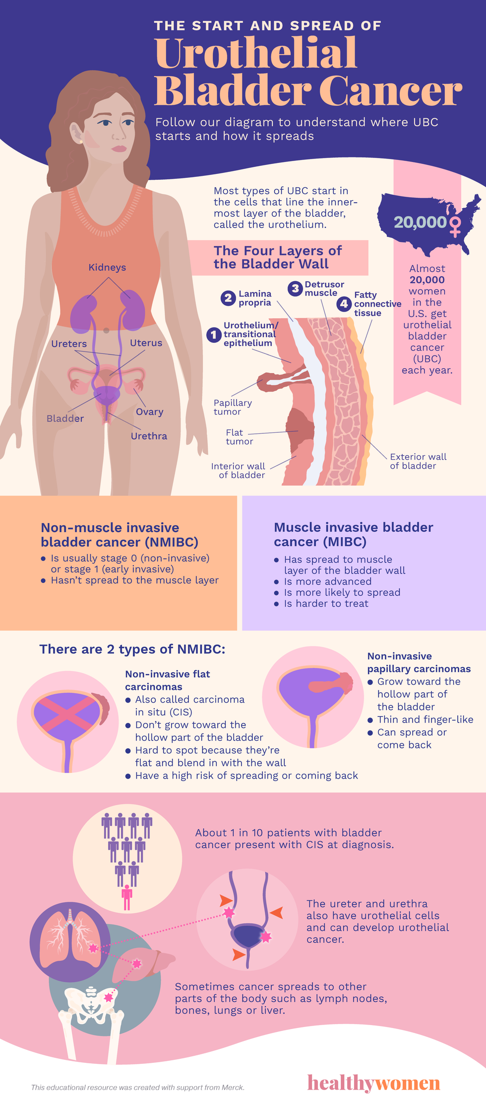 The Start and Spread of Urothelial Bladder Cancer infographic. Click to view PDF