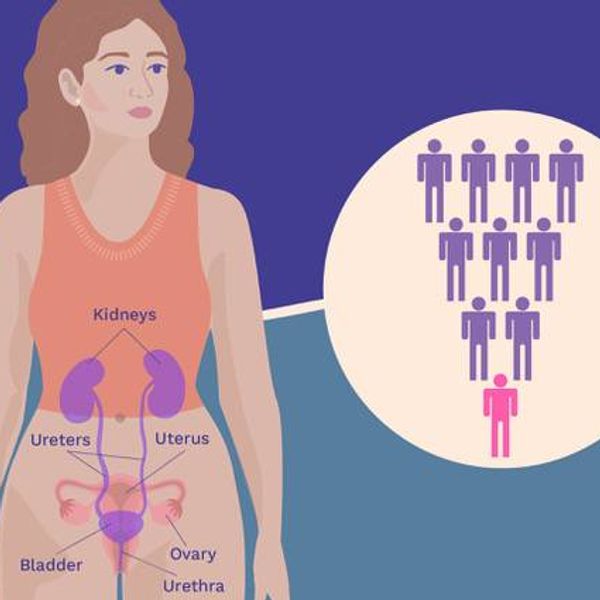 The Start and Spread of Urothelial Bladder Cancer infographic