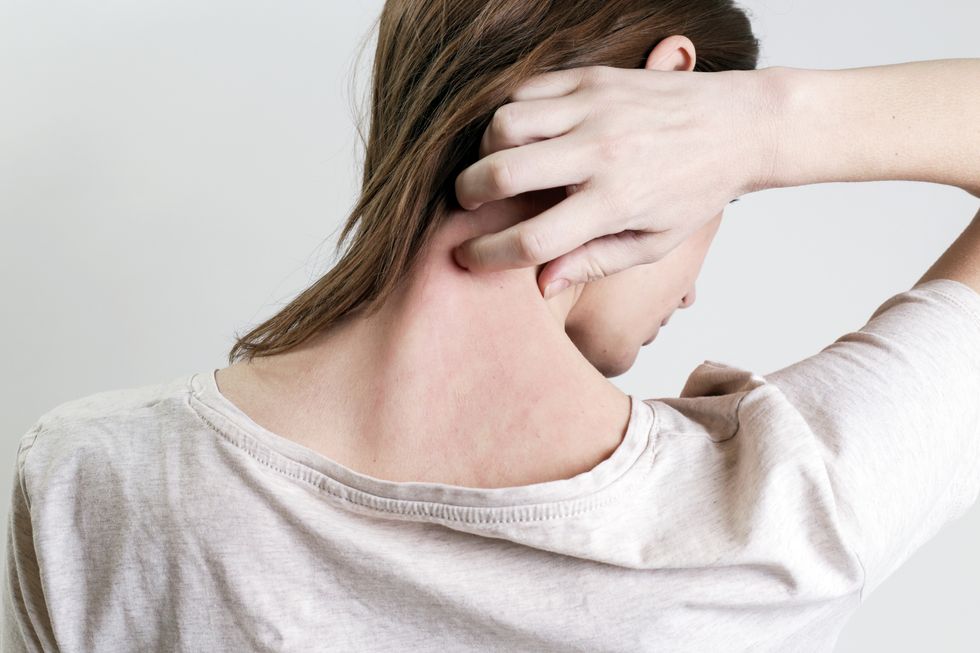 The Stigma of Psoriasis