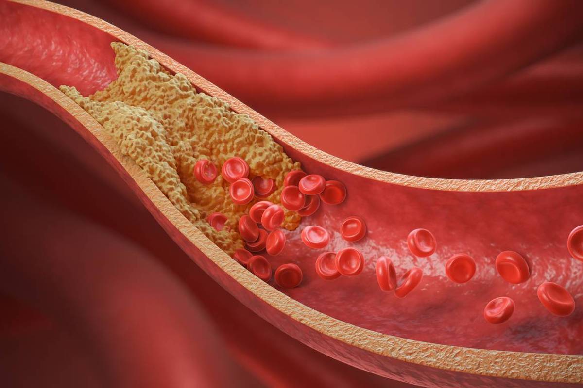 Thickened Arteries and Veins, Red Blood Cells
