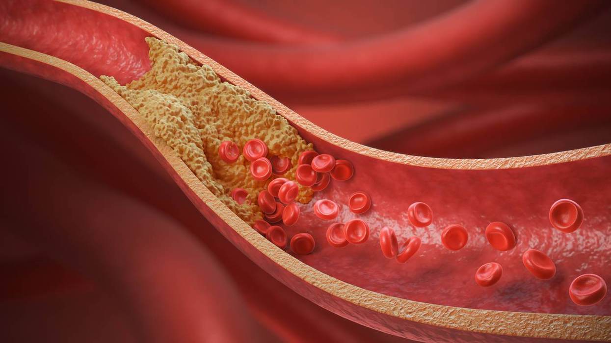 What Women Need to Know About Cholesterol