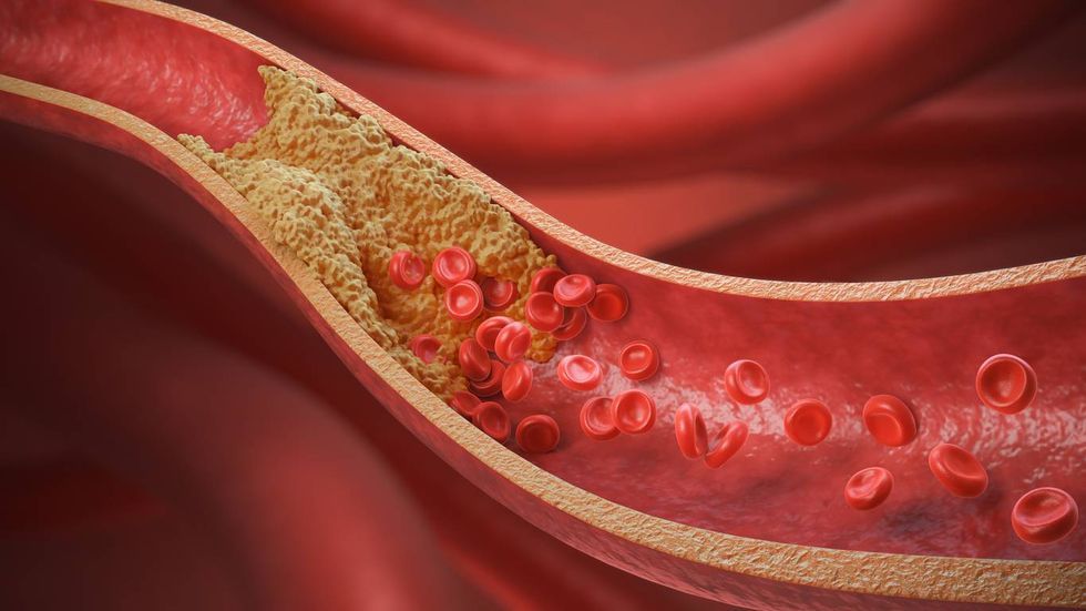thickened arteries and veins red blood cells