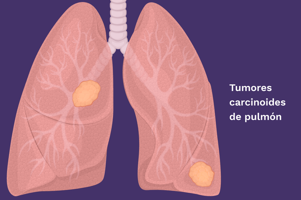 Tumores carcinoides de pulm\u00f3n