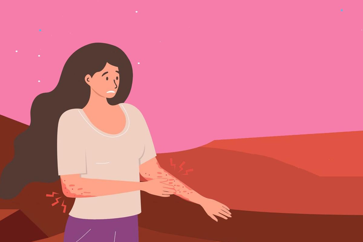 Type 2 Inflammation May Be Contributing to Your Atopic Dermatitis graphic