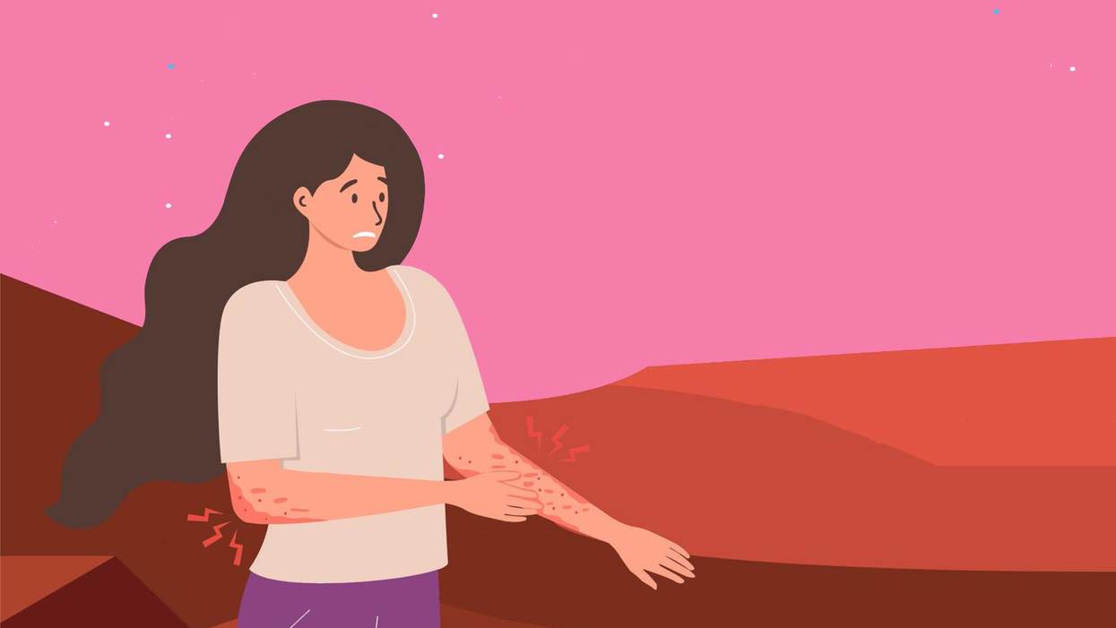 Type 2 Inflammation May Be Contributing to Your Atopic Dermatitis