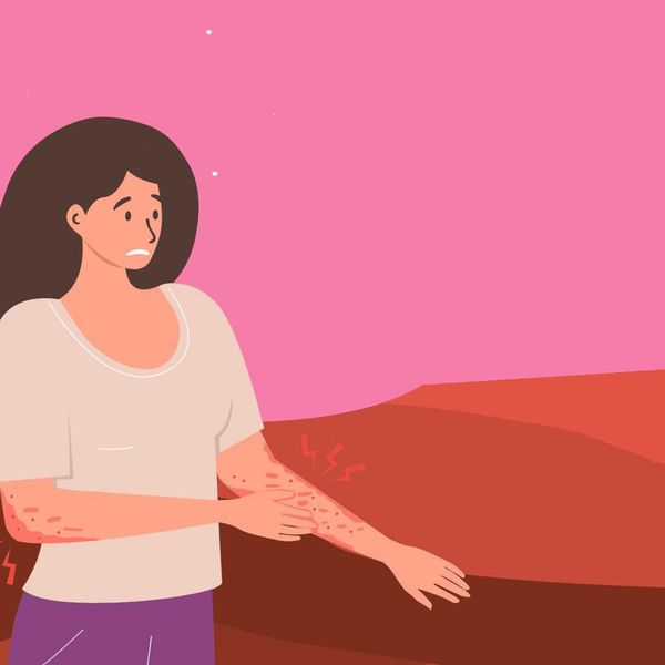 Type 2 Inflammation May Be Contributing to Your Atopic Dermatitis graphic