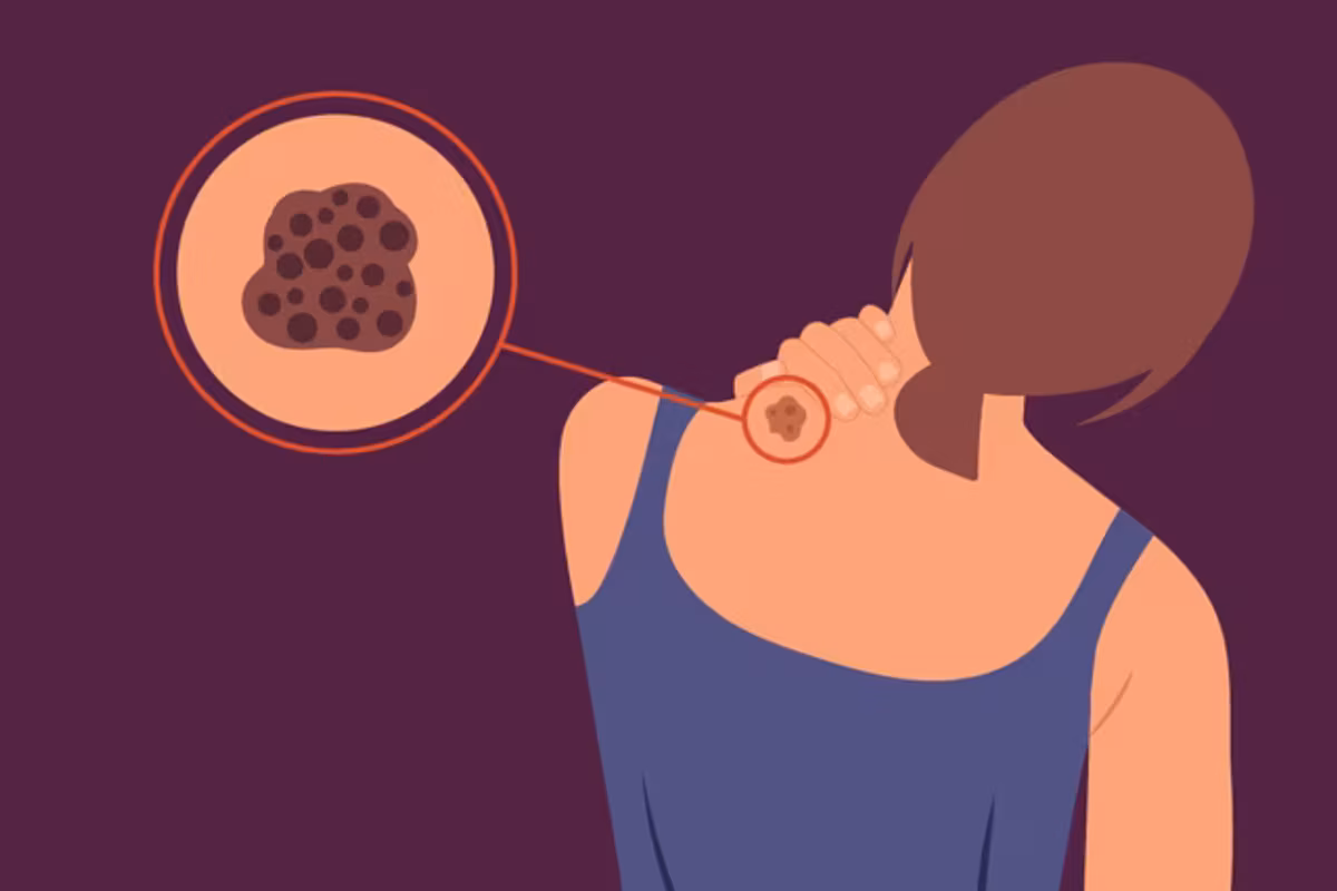 Types of Melanoma infographic