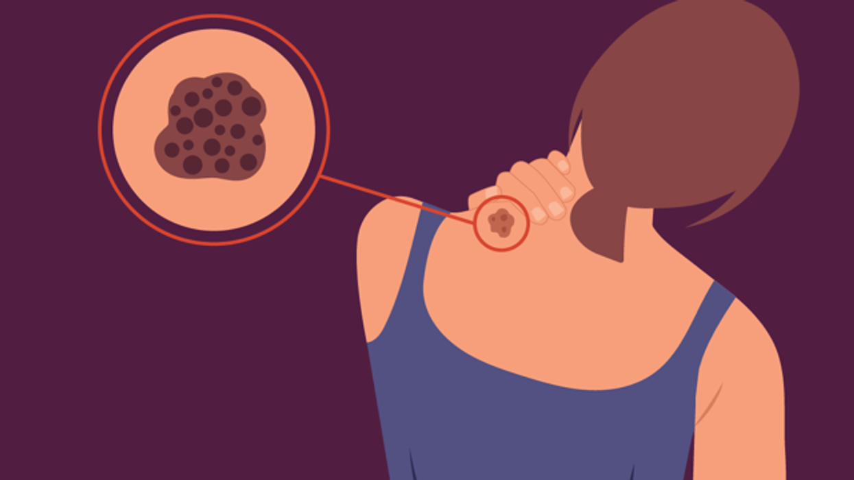 Types of Melanoma infographic