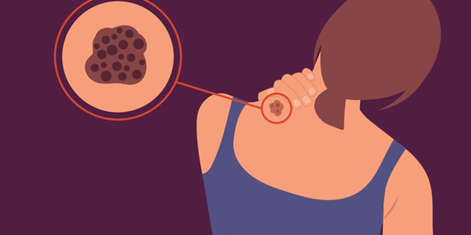 Types of Melanoma infographic