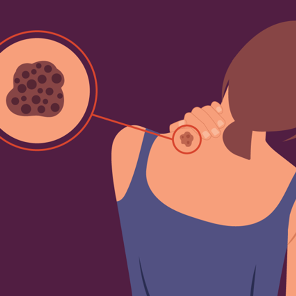 Types of Melanoma infographic