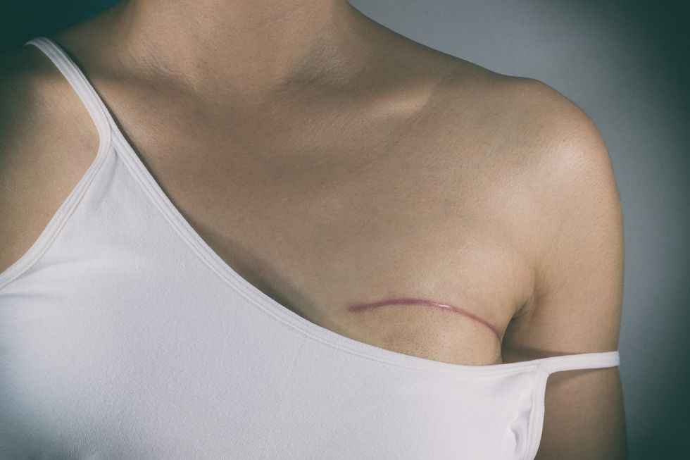 Unnecessary Mastectomies