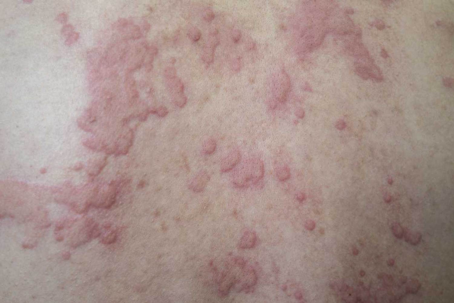 Chronic Spontaneous Urticaria 101