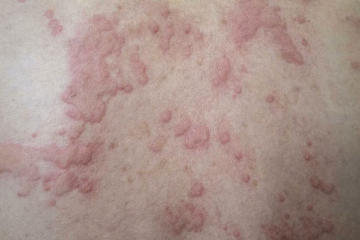 Urticaria