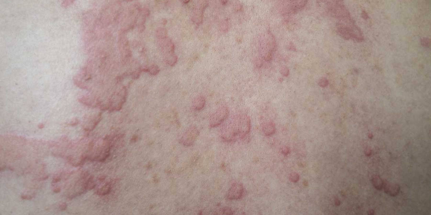 Urticaria