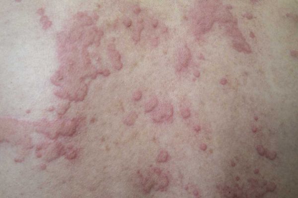 Urticaria