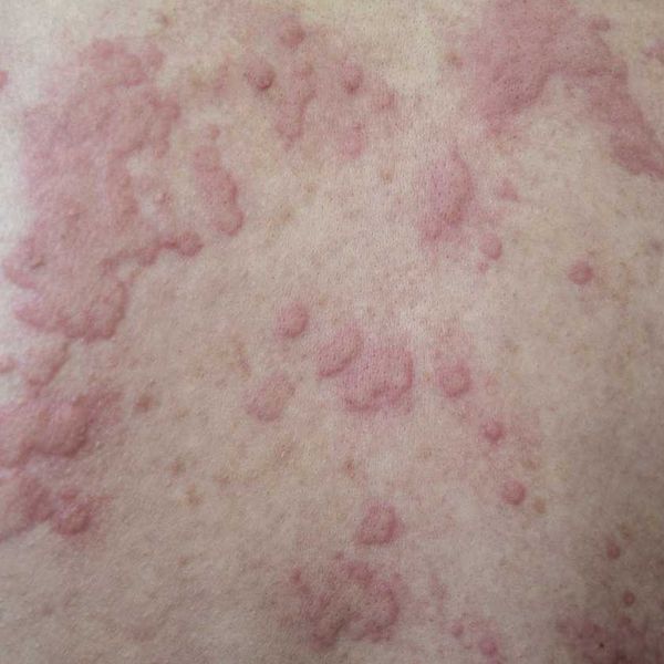 Urticaria