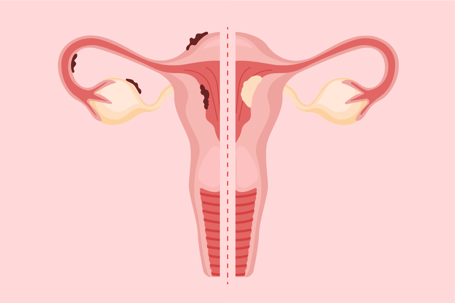 Is It Endometriosis or Endometrial Cancer?