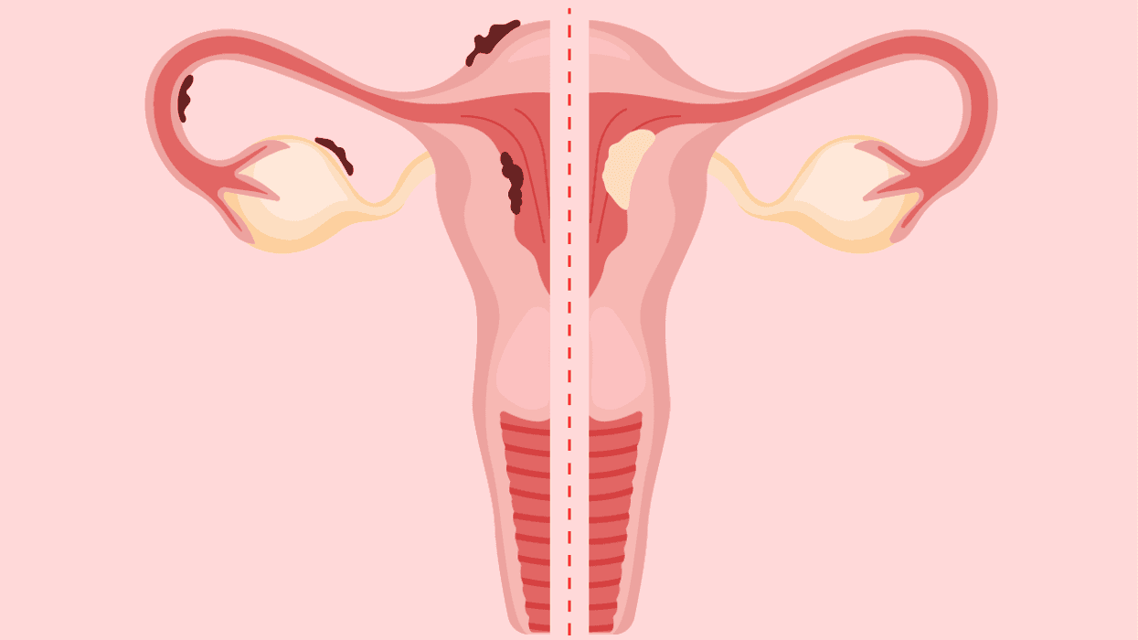 Is It Endometriosis or Endometrial Cancer?