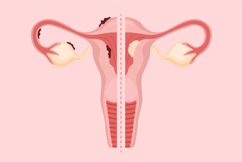 Endometriosis