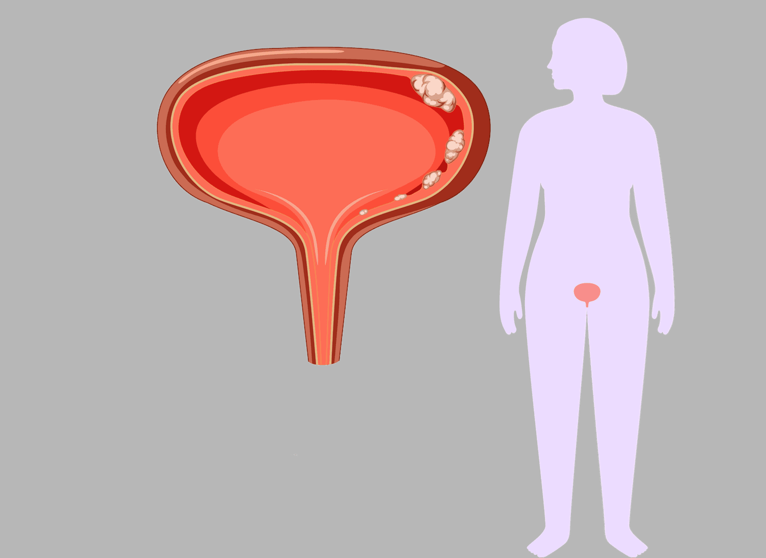 Vivir con cáncer de vejiga