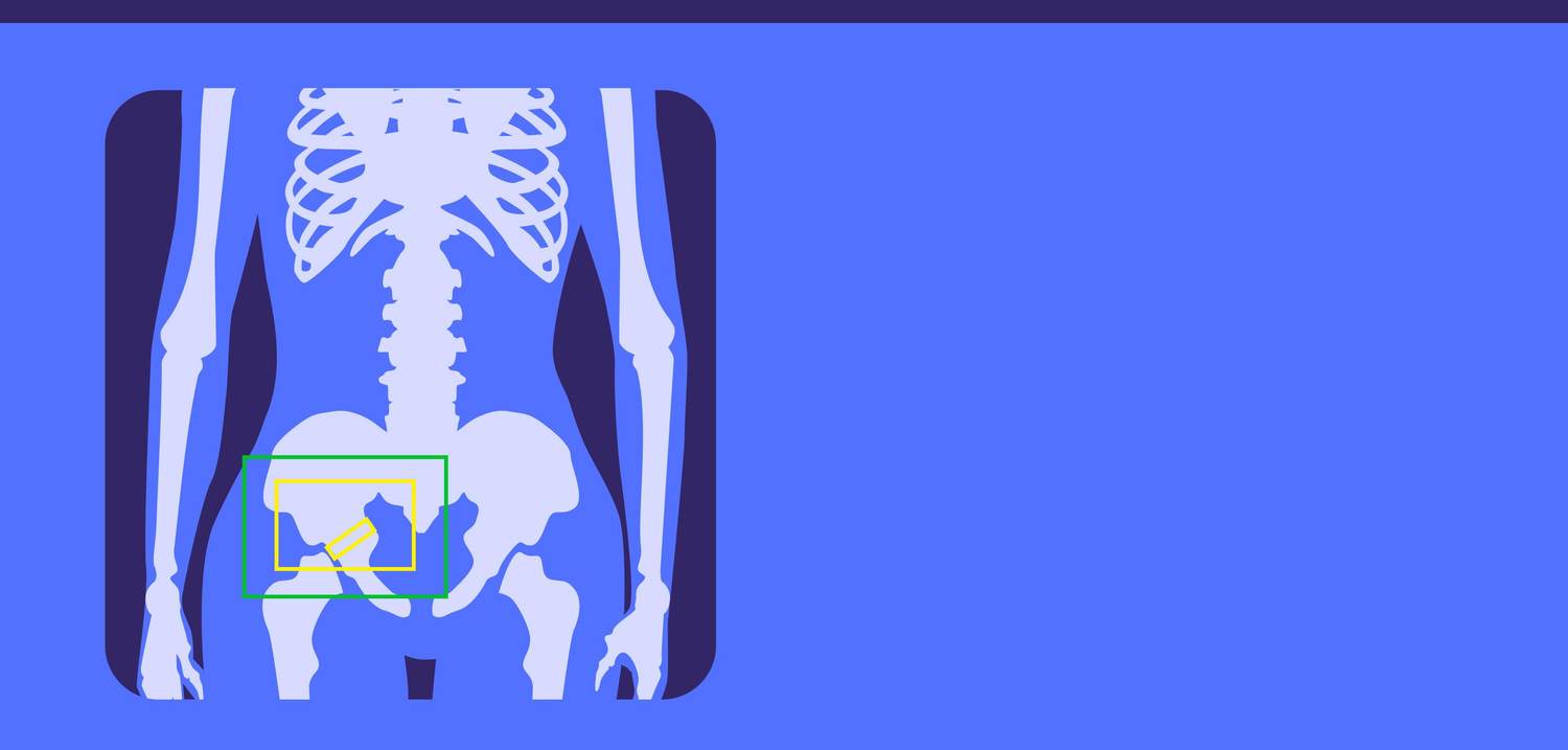 What Increases Your Risk for Bone Fractures and Osteoporosis?