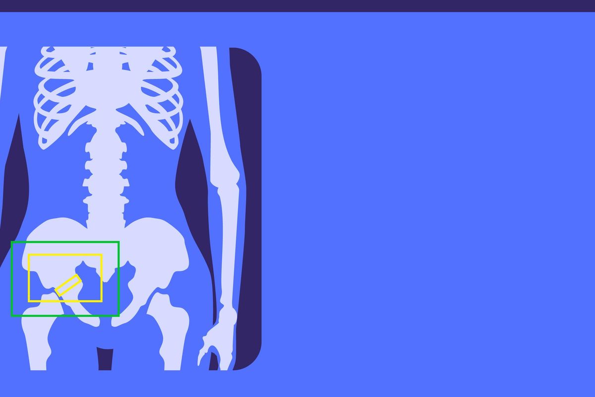 What Increases Your Risk for Bone Fractures and Osteoporosis?