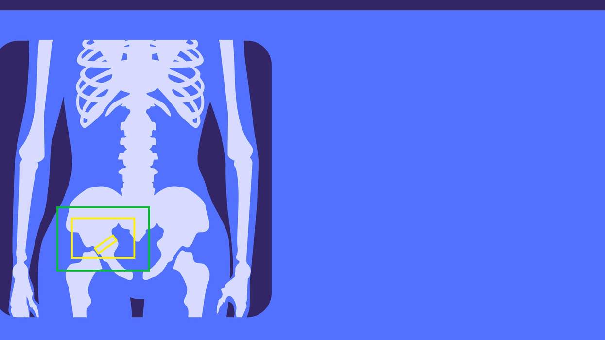 What Increases Your Risk for Bone Fractures and Osteoporosis?