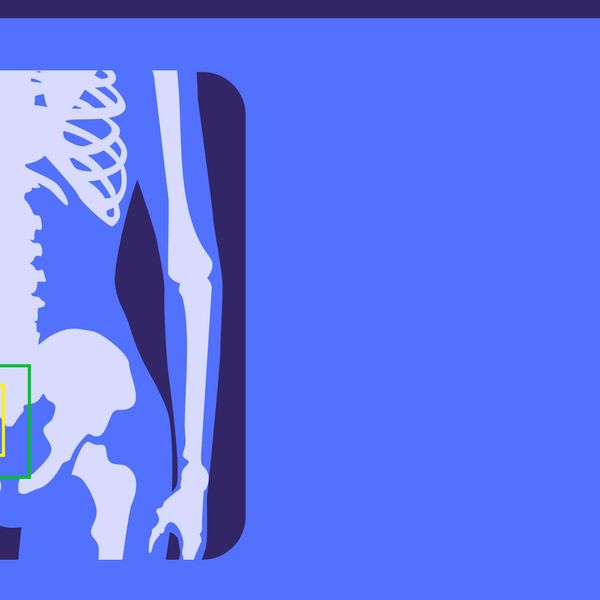 What Increases Your Risk for Bone Fractures and Osteoporosis?
