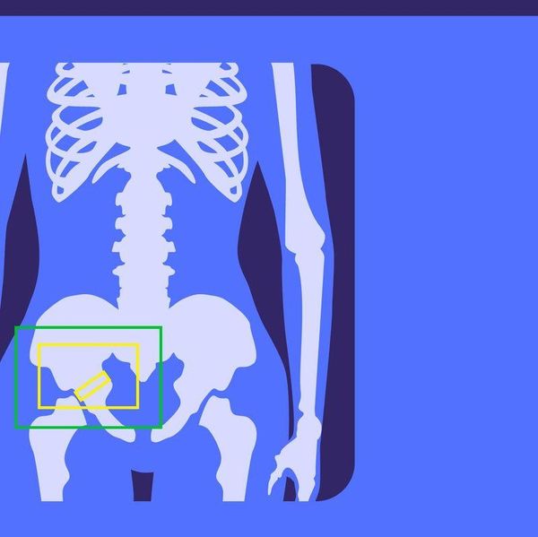 What Increases Your Risk for Bone Fractures and Osteoporosis?
