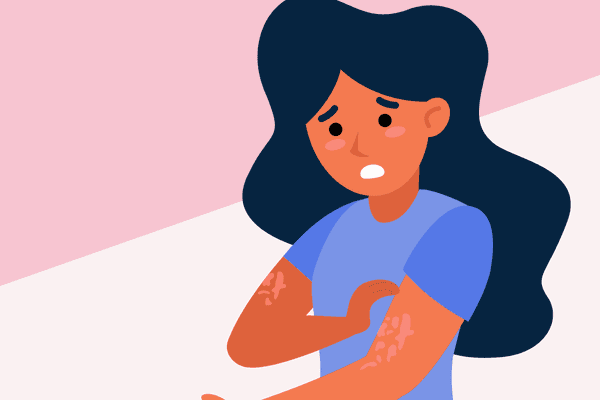 What Is Chronic Spontaneous Urticaria (CSU)? infographic