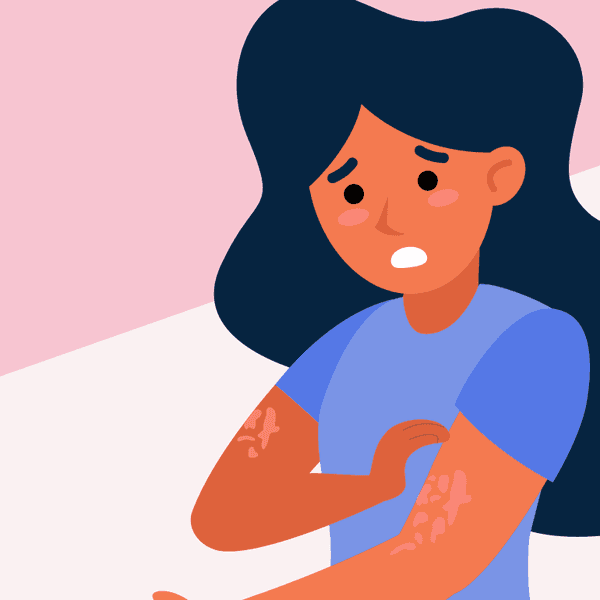 What Is Chronic Spontaneous Urticaria (CSU)? infographic