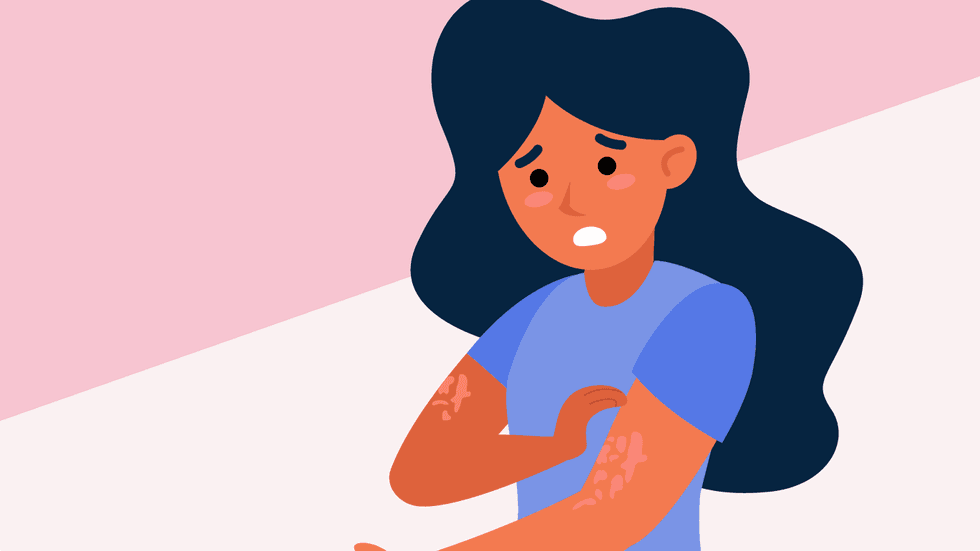 What Is Chronic Spontaneous Urticaria (CSU)?