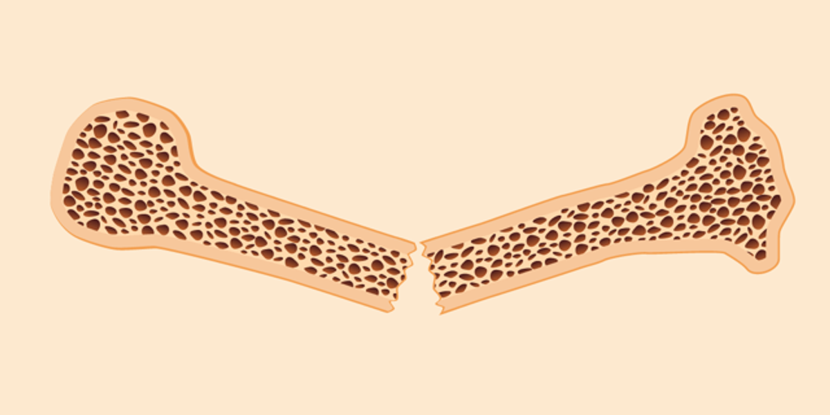 What Is Osteoporosis and How Do You Treat It?