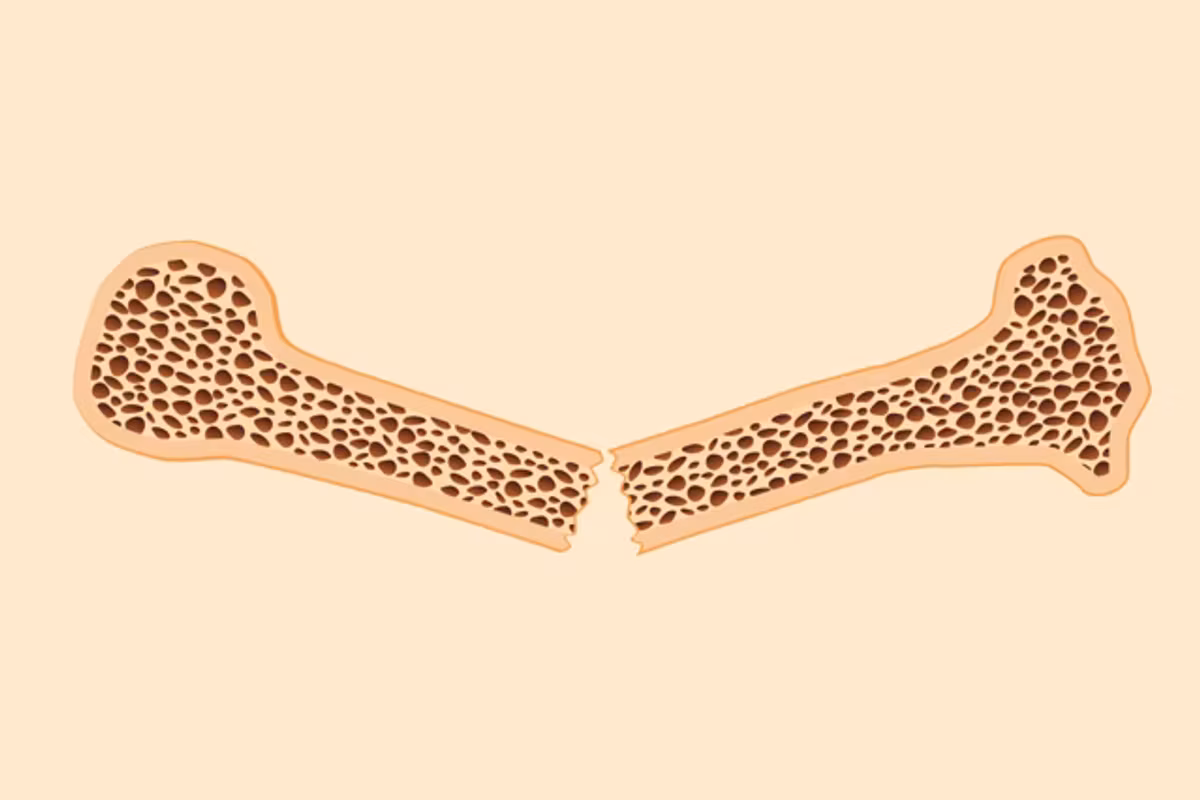 What Is Osteoporosis and How Do You Treat It? infographic