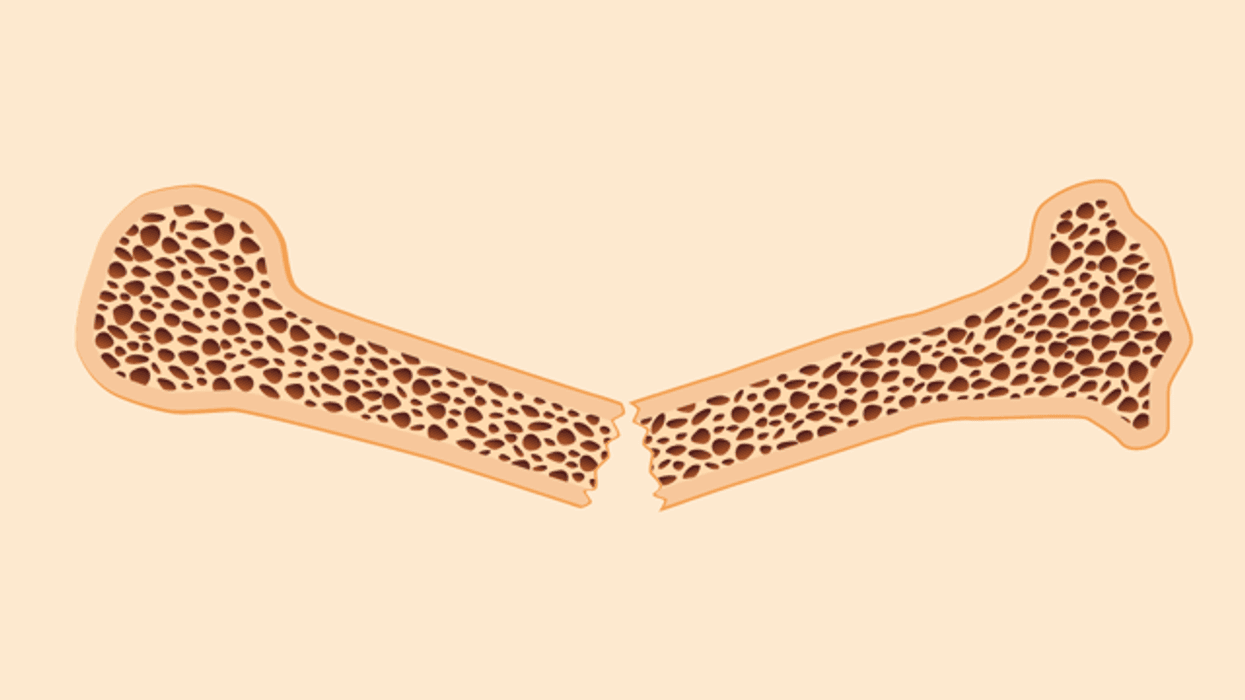 What Is Osteoporosis and How Do You Treat It?