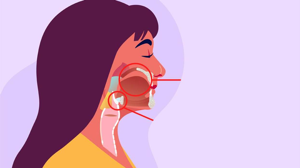 What Is the Link Between HPV & Head and Neck Cancers?
