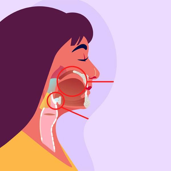 What Is the Link Between HPV & Head and Neck Cancers? Infographic