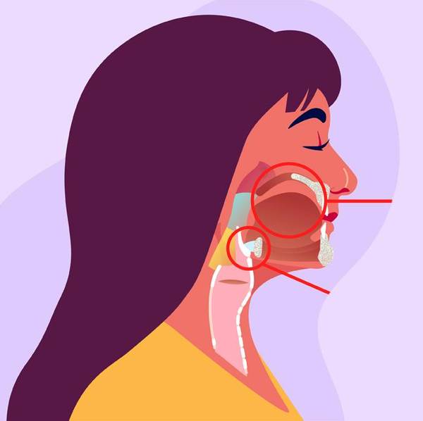 What Is the Link Between HPV & Head and Neck Cancers?